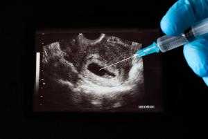 Минздрав установил медицинские показания для аборта