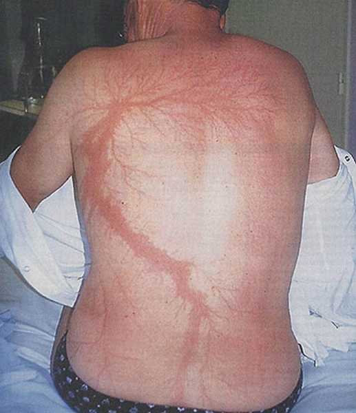 15 несчастных случаев, когда на телах людей на всю жизнь остаются шрамы от электрического разряда молнии