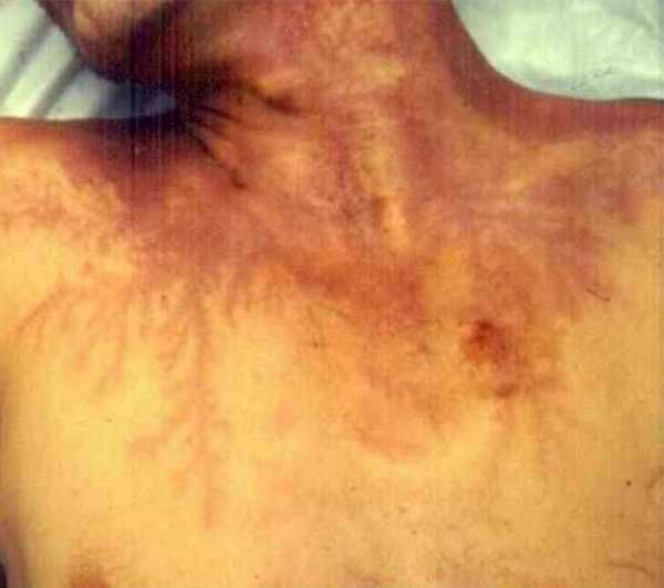 15 несчастных случаев, когда на телах людей на всю жизнь остаются шрамы от электрического разряда молнии