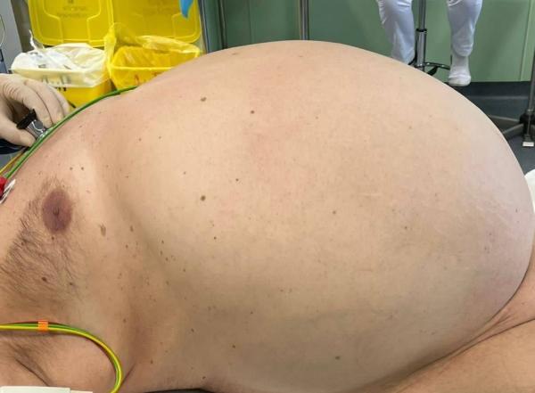 «Операция длилась три часа»: петербургские врачи рассказали, как удаляли пациенту 26-килограммовую опухоль