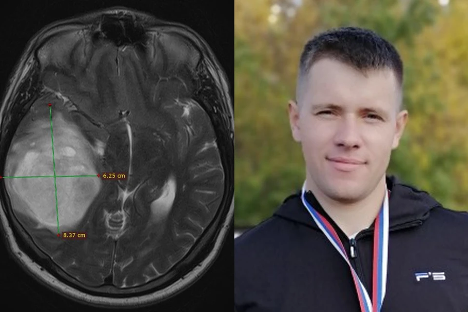 Под Новосибирском у учителя нашли в голове опухоль после того, как он переболел «омикроном»